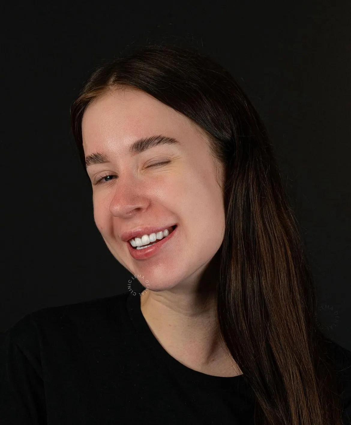 smile hollywood patient 55