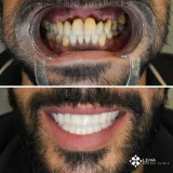 smile hollywood patient 49 smile hollywood patient 56