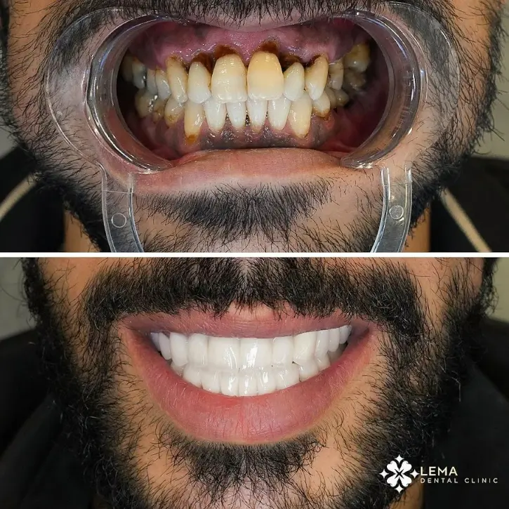 smile hollywood patient 56