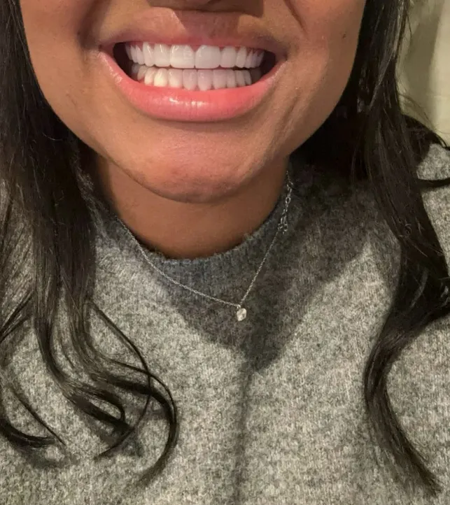 smile hollywood patient 57