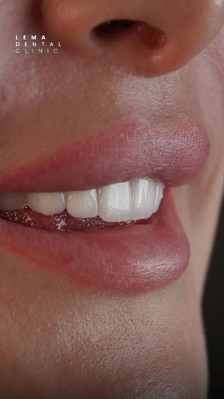 smile hollywood patient 58