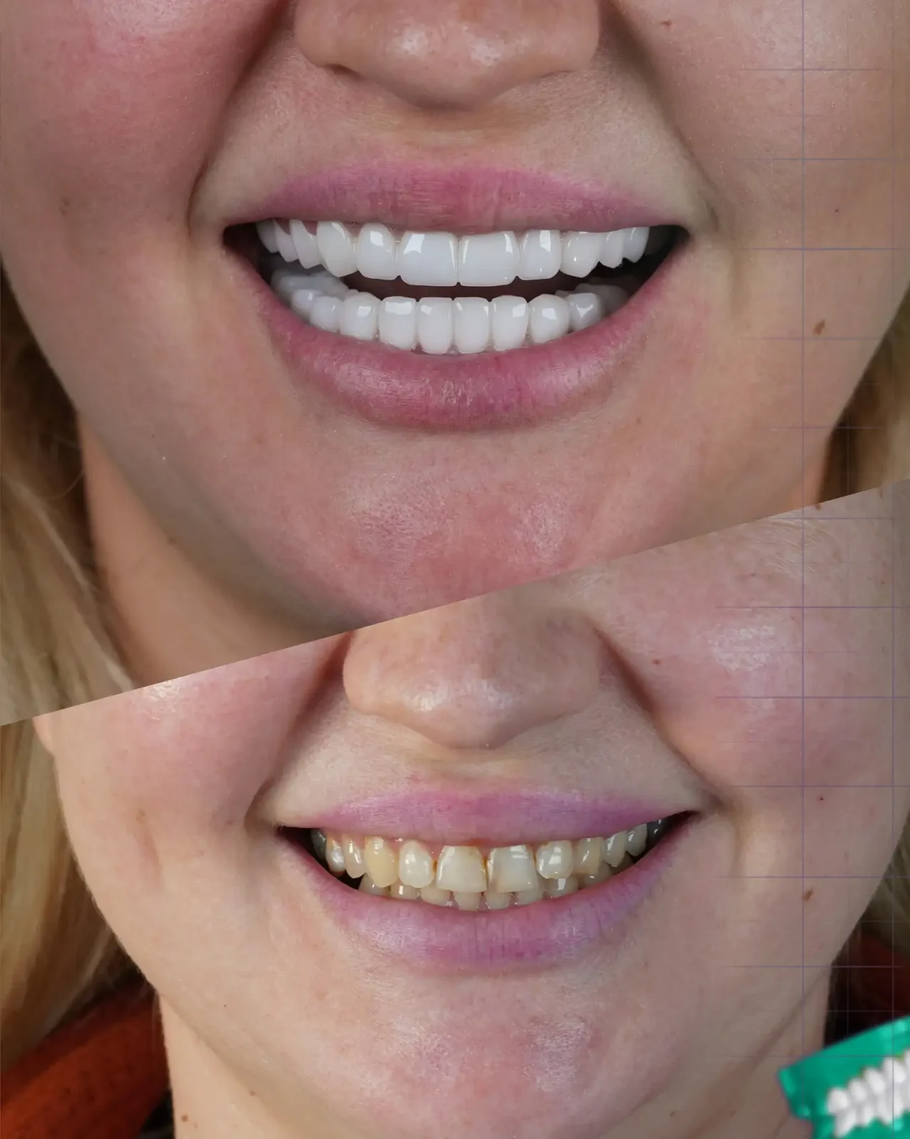 smile hollywood patient 59