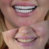 smile hollywood patient 73 smile hollywood patient 59
