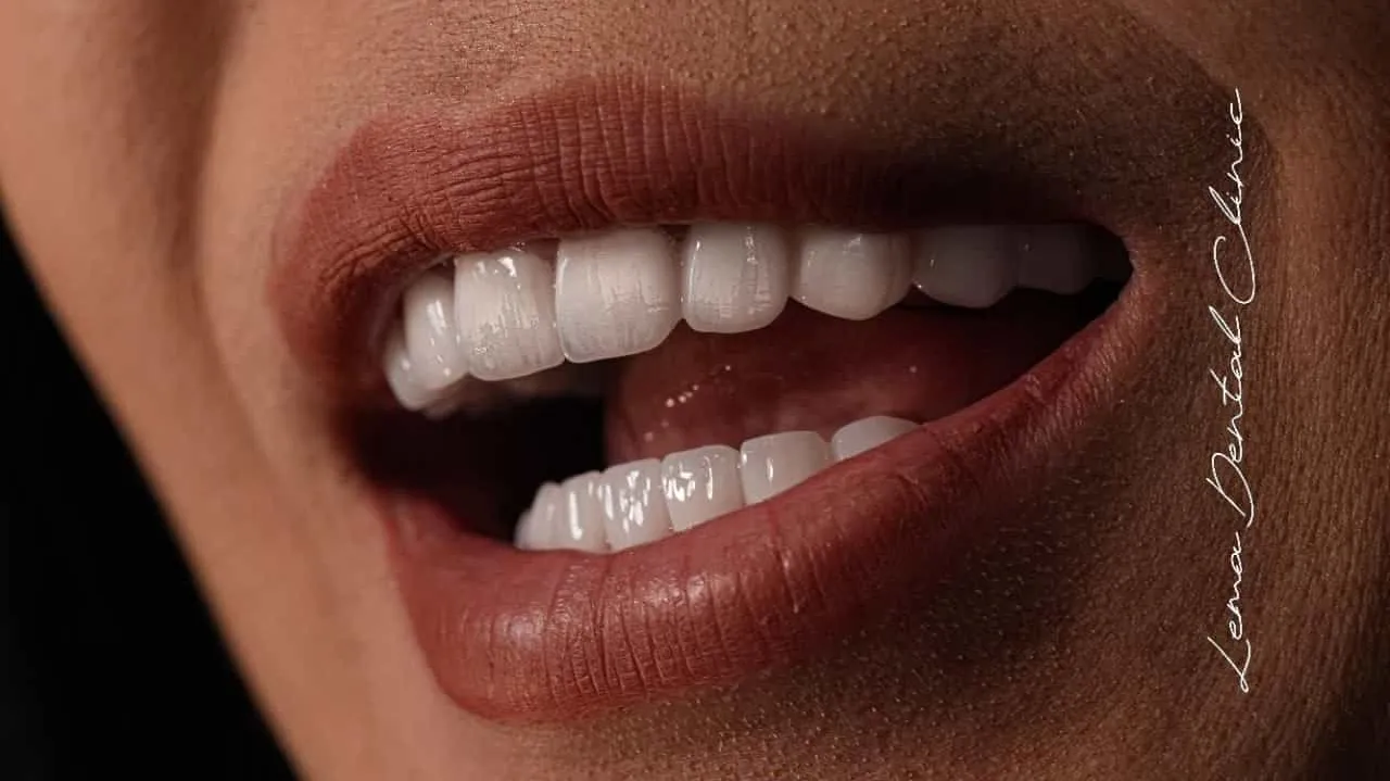 smile hollywood patient 6