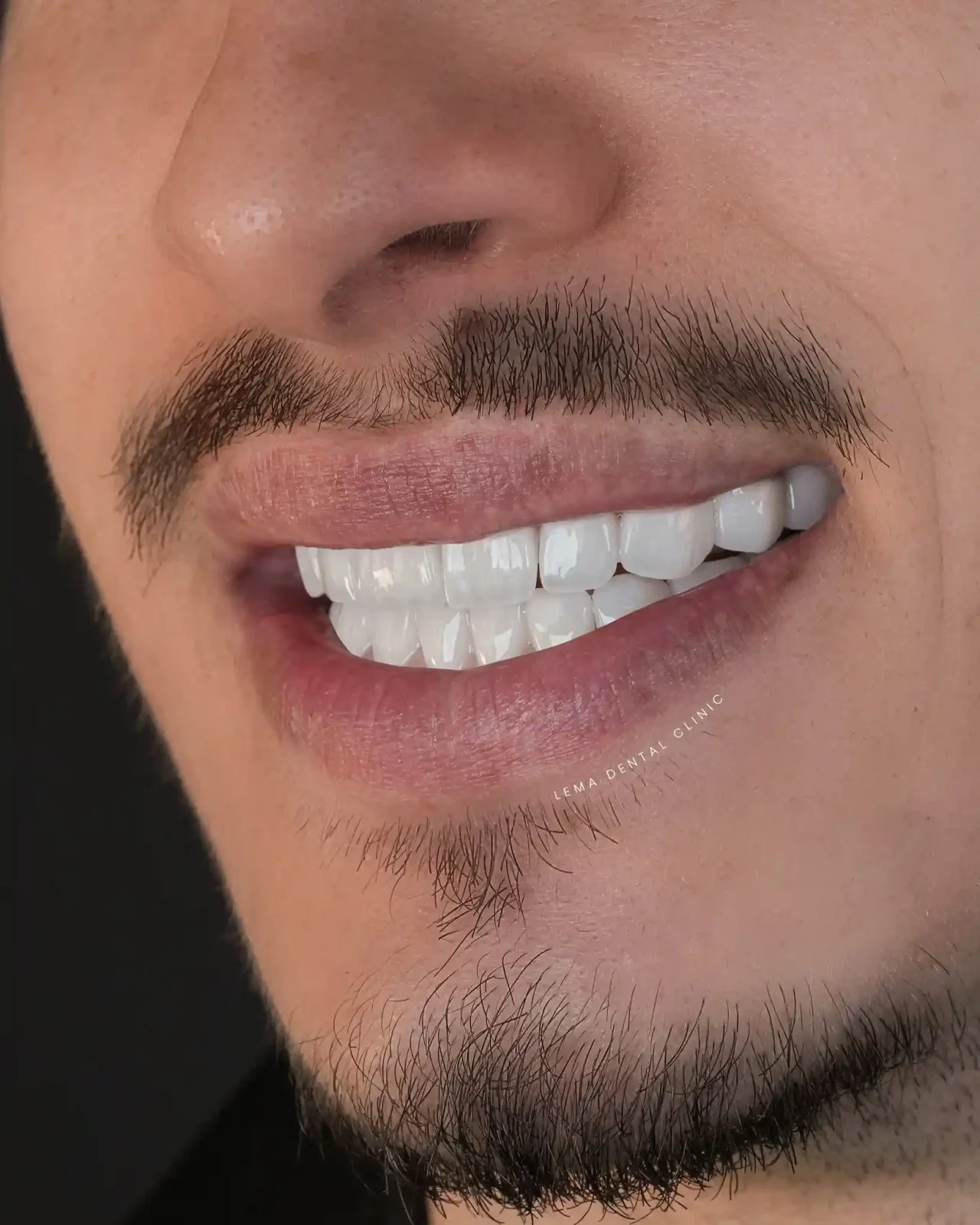 smile hollywood patient 60