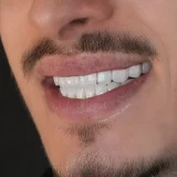smile hollywood patient 60
