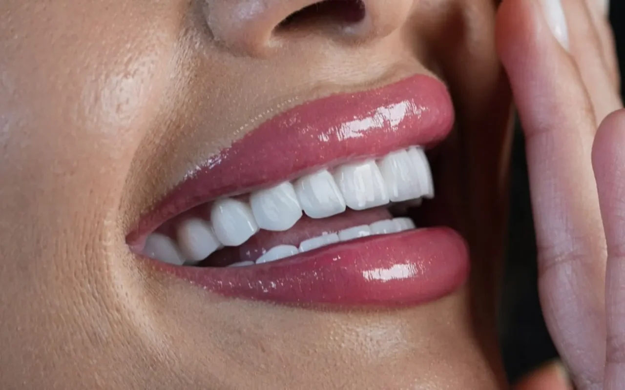 smile hollywood patient 61