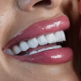 smile hollywood patient 61