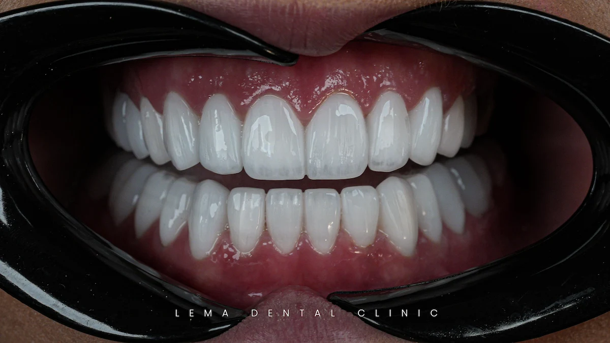 smile hollywood patient 63