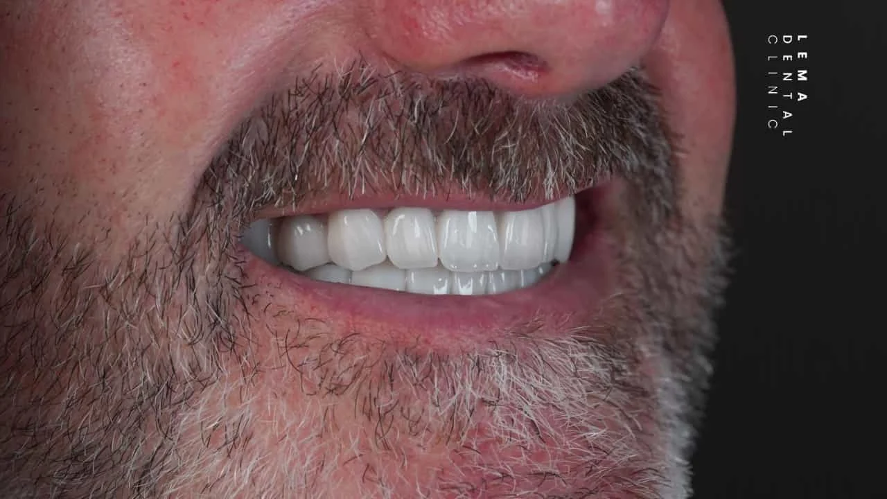 smile hollywood patient 64