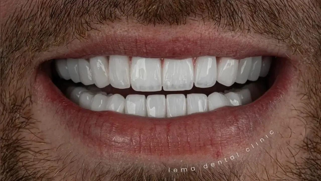 smile hollywood patient 65