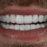 smile hollywood patient 65