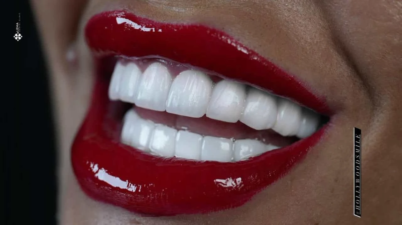 smile hollywood patient 66