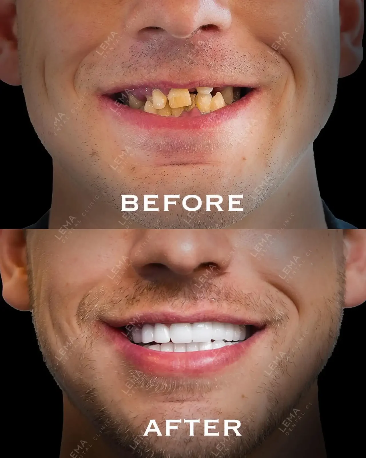 smile hollywood patient 69