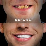 smile hollywood patient 81 smile hollywood patient 69