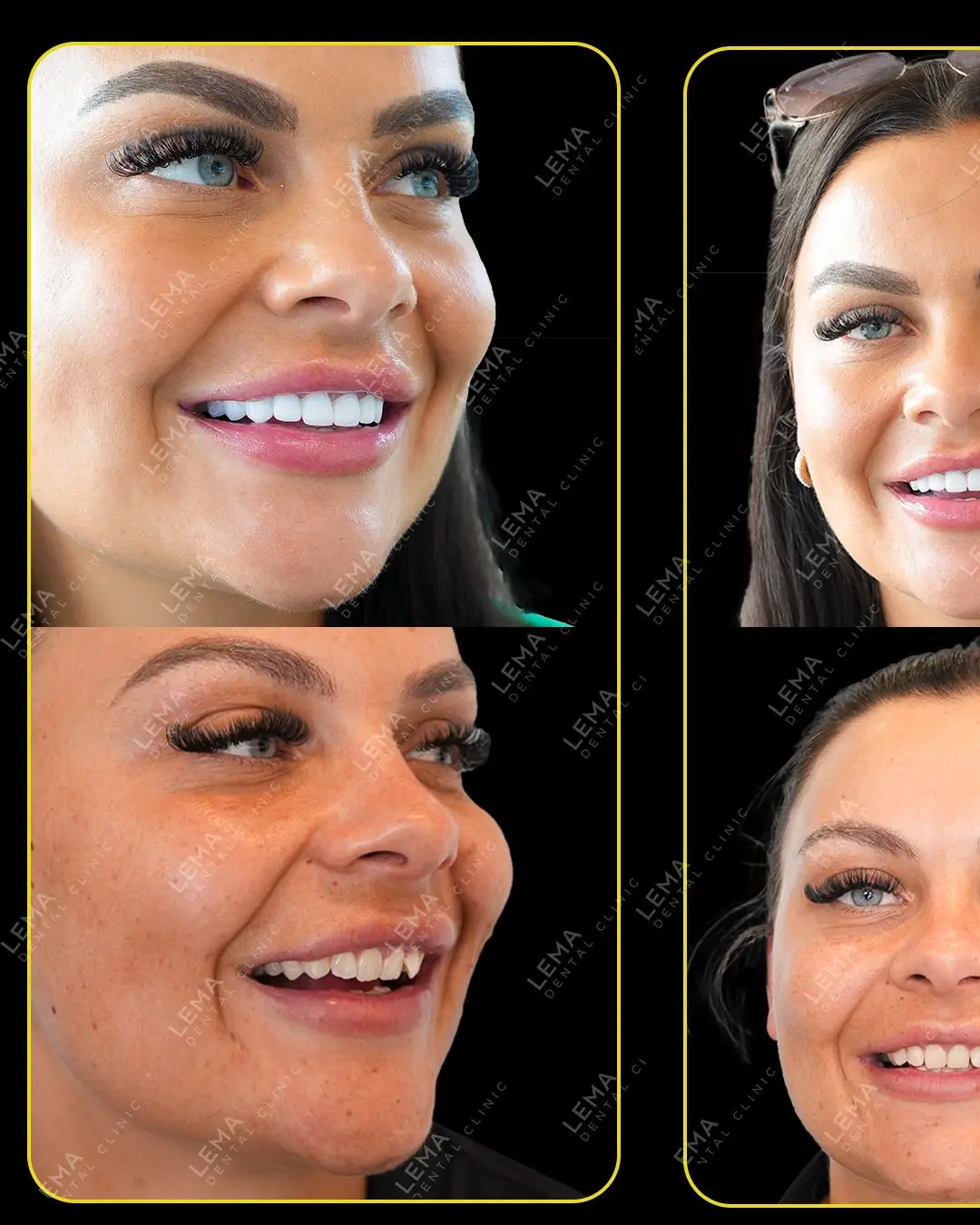 smile hollywood patient 7