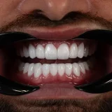smile hollywood patient 75 smile hollywood patient 71