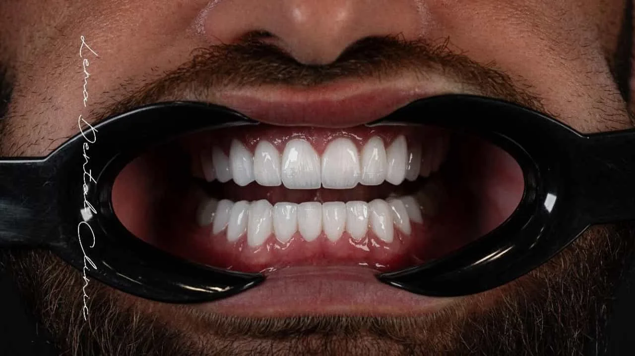 smile hollywood patient 71