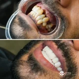 smile hollywood patient 80 smile hollywood patient 74