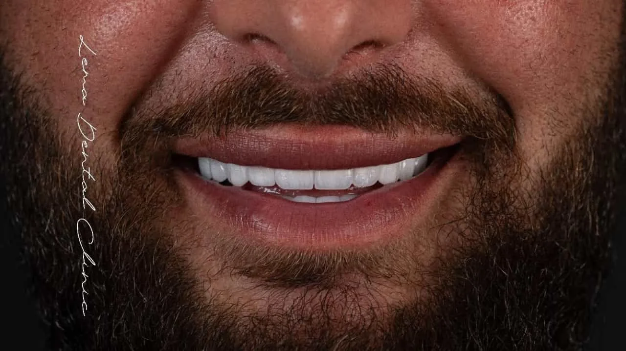 smile hollywood patient 76
