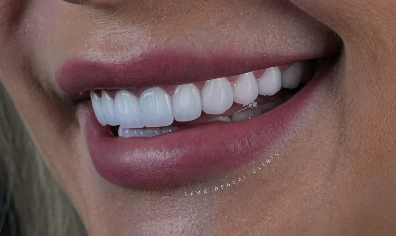 smile hollywood patient 78