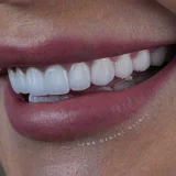 smile hollywood patient 80 smile hollywood patient 78