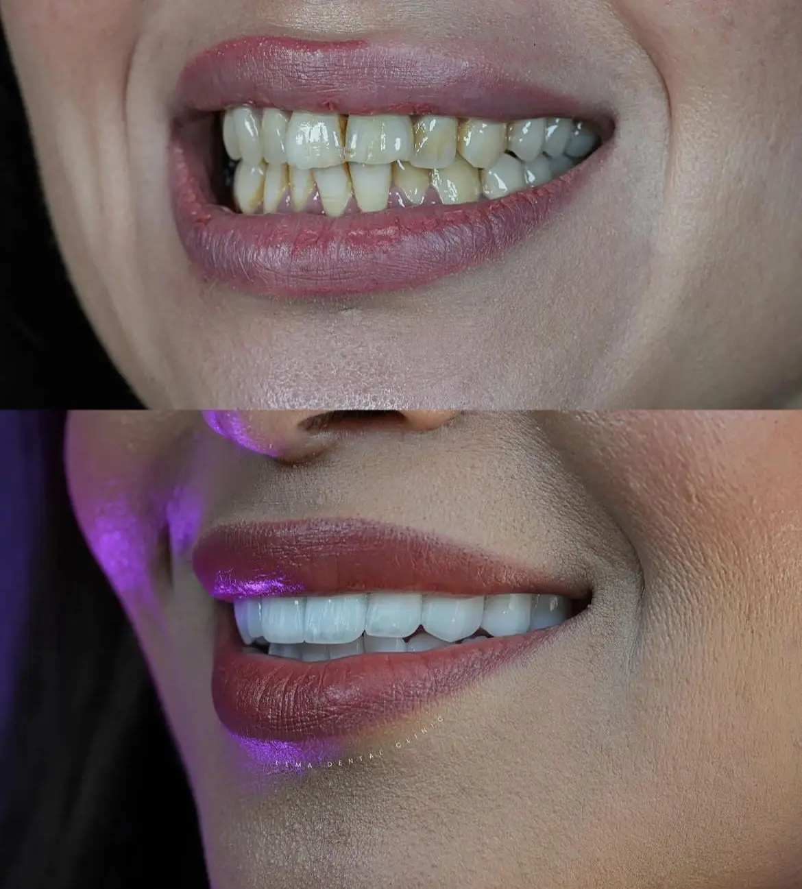 smile hollywood patient 8