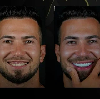 Dental Crown Before and After in Turkey! smile hollywood patient 82