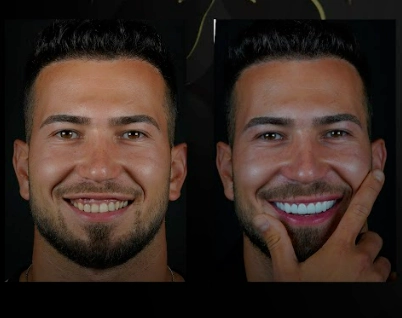 smile hollywood patient 82