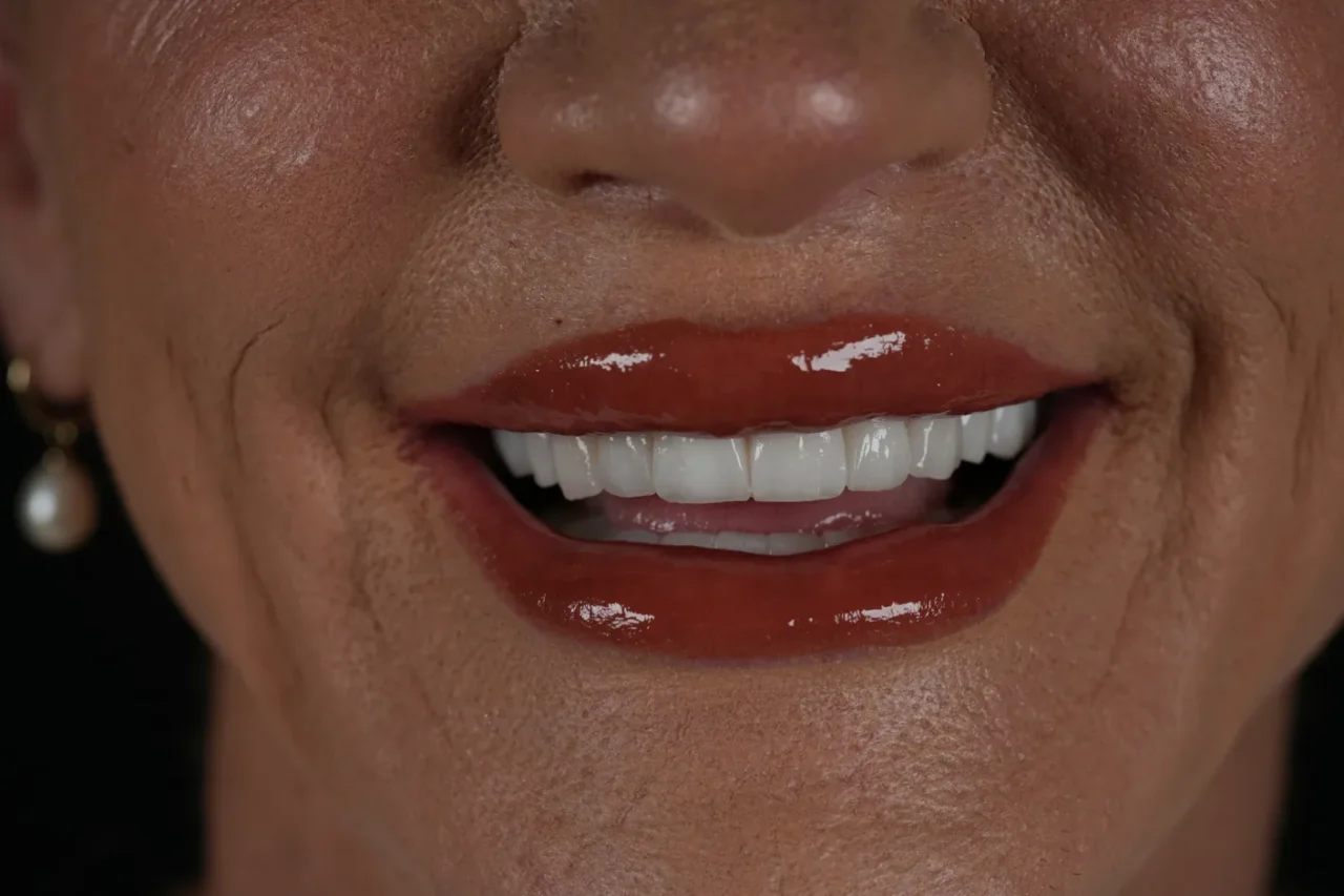 smile hollywood patient 83