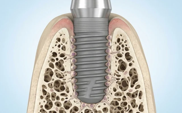 all on 5 dental implants turkey 1