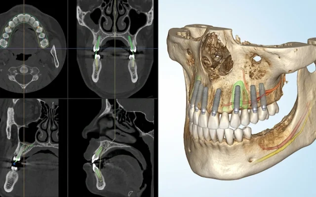 all on 5 dental implants turkey 2