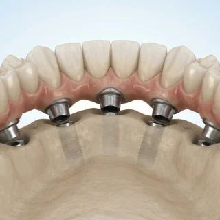 all on 5 dental implants turkey 3