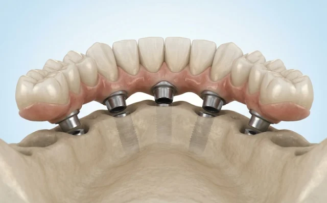 all on 5 dental implants turkey 3