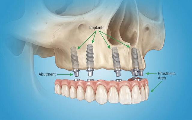 all on 6 dental implants turkey 2 all on 6 dental implants turkey 2