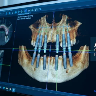 all on 6 dental implants turkey 5