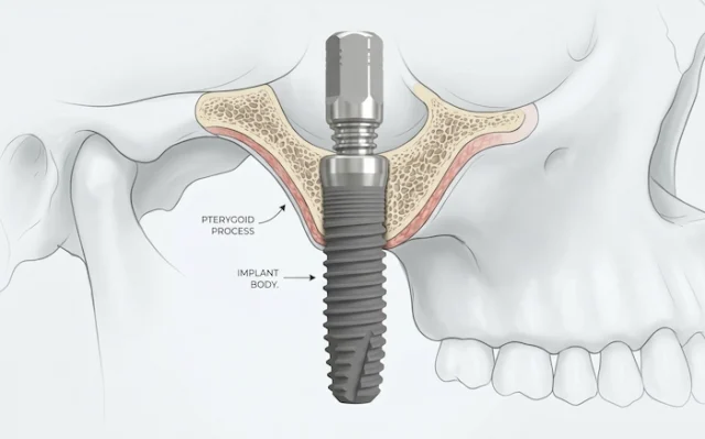 pterygoid dental implants turkey 1