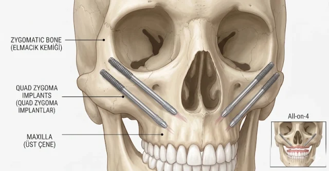 quad zygoma dental implants in turkey 1