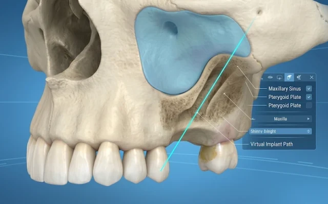 trans sinus dental implants in turkey 1 trans sinus dental implants in turkey 1