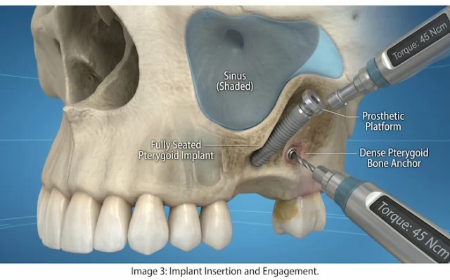 trans sinus dental implants in turkey 3 trans sinus dental implants in turkey 3