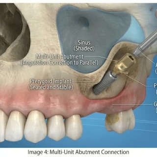 trans sinus dental implants in turkey 4