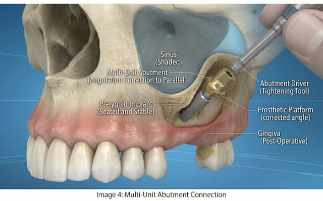 trans sinus dental implants in turkey 4 trans sinus dental implants in turkey 4