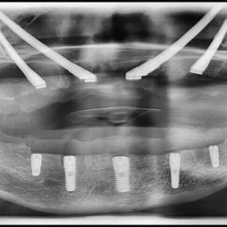 All-on-8 Dental Implants Turkey! zygomatic implants in istanbul turkey dental xrays