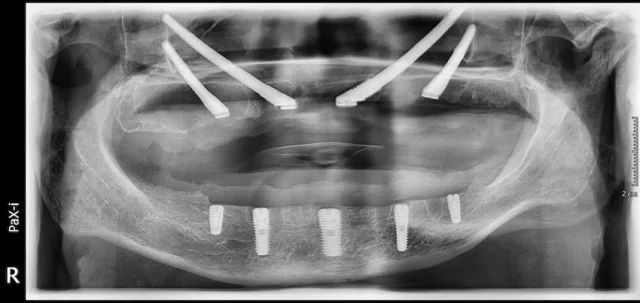 zygomatic implants in istanbul turkey dental xrays